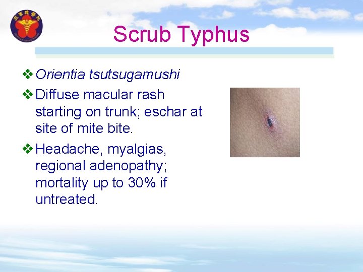 Scrub Typhus v Orientia tsutsugamushi v Diffuse macular rash starting on trunk; eschar at Scrub Typhus v Orientia tsutsugamushi v Diffuse macular rash starting on trunk; eschar at