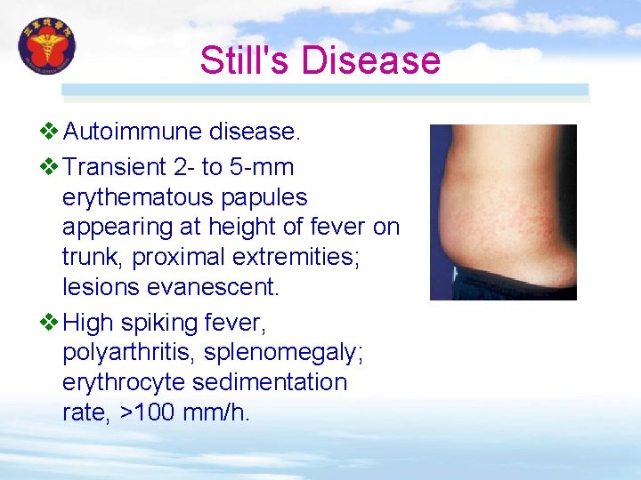 Still's Disease v Autoimmune disease. v Transient 2 - to 5 -mm erythematous papules Still's Disease v Autoimmune disease. v Transient 2 - to 5 -mm erythematous papules