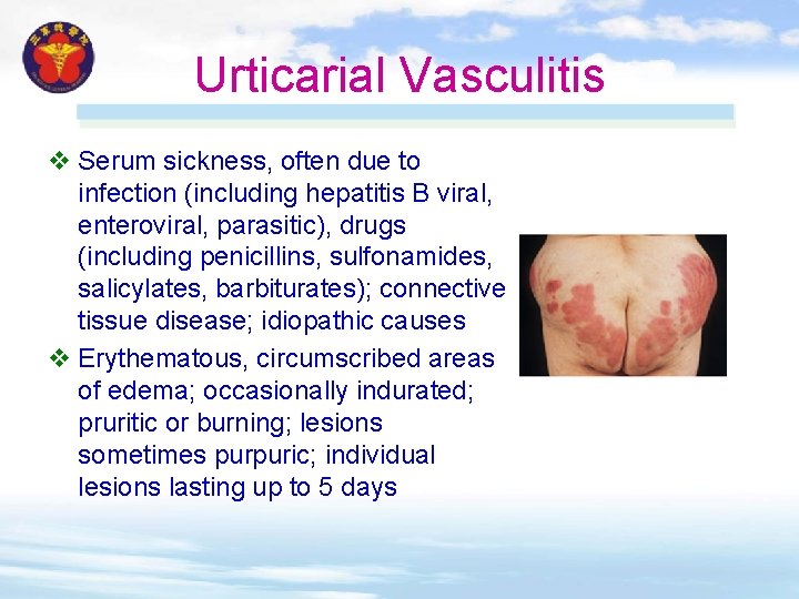 Urticarial Vasculitis v Serum sickness, often due to infection (including hepatitis B viral, enteroviral, Urticarial Vasculitis v Serum sickness, often due to infection (including hepatitis B viral, enteroviral,