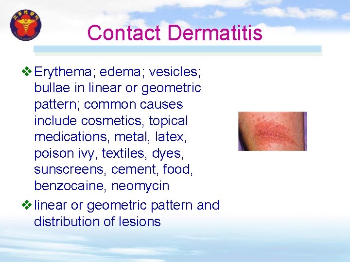Contact Dermatitis v Erythema; edema; vesicles; bullae in linear or geometric pattern; common causes Contact Dermatitis v Erythema; edema; vesicles; bullae in linear or geometric pattern; common causes