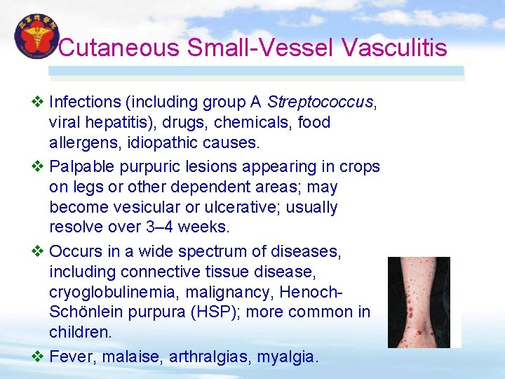 Cutaneous Small-Vessel Vasculitis v Infections (including group A Streptococcus, viral hepatitis), drugs, chemicals, food Cutaneous Small-Vessel Vasculitis v Infections (including group A Streptococcus, viral hepatitis), drugs, chemicals, food