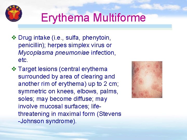 Erythema Multiforme v Drug intake (i. e. , sulfa, phenytoin, penicillin); herpes simplex virus Erythema Multiforme v Drug intake (i. e. , sulfa, phenytoin, penicillin); herpes simplex virus