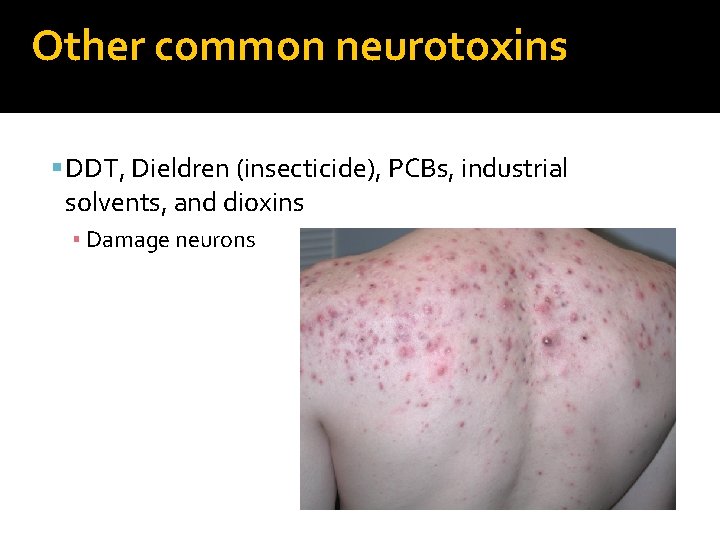 Other common neurotoxins DDT, Dieldren (insecticide), PCBs, industrial solvents, and dioxins ▪ Damage neurons