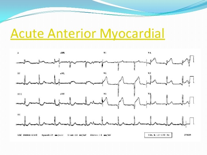 Acute Anterior Myocardial 