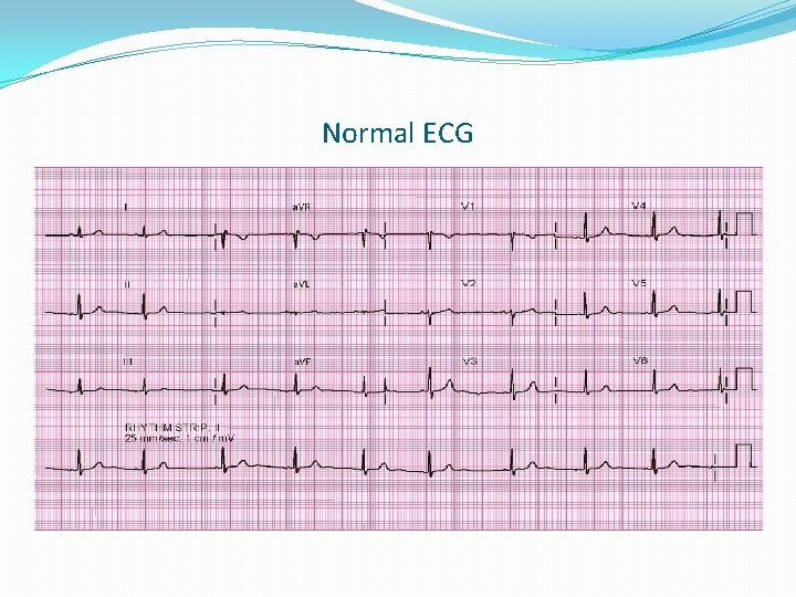 Normal ECG 