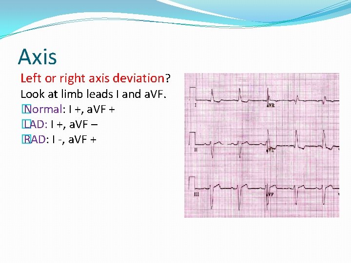 Axis Left or right axis deviation? Look at limb leads I and a. VF.