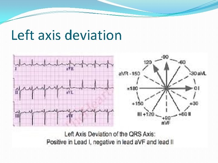 Left axis deviation 