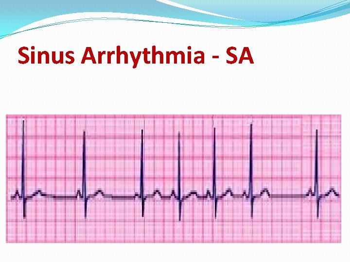 Sinus Arrhythmia - SA 