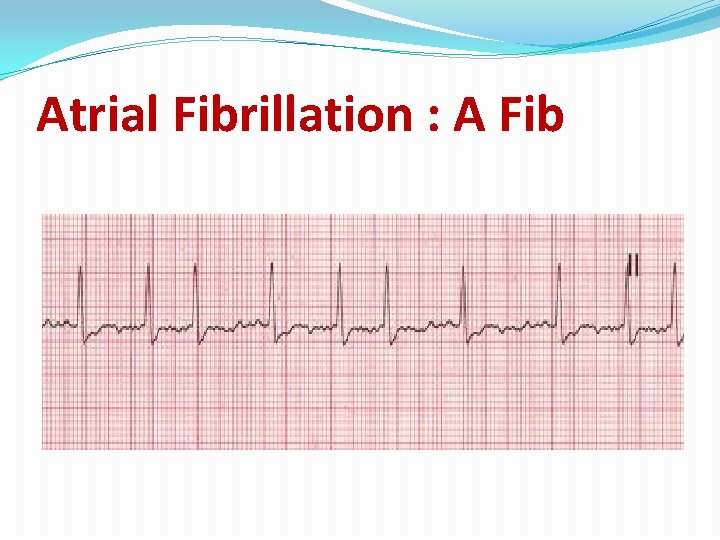 Atrial Fibrillation : A Fib 