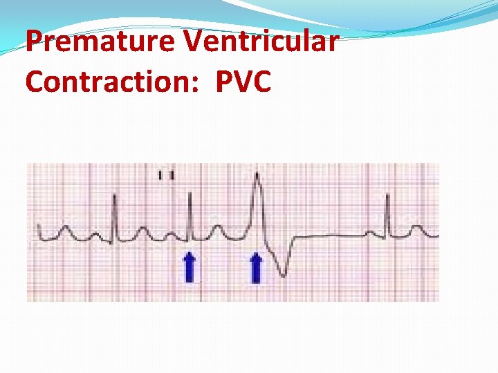 Premature Ventricular Contraction: PVC 