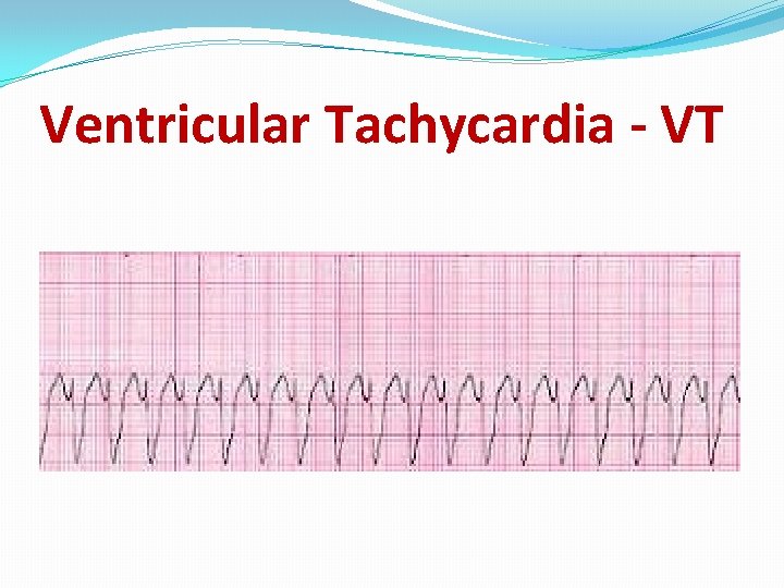 Ventricular Tachycardia - VT 