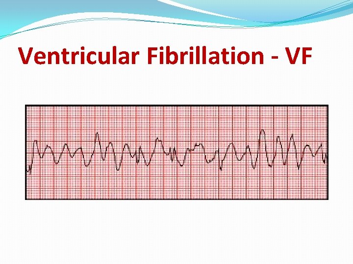 Ventricular Fibrillation - VF 