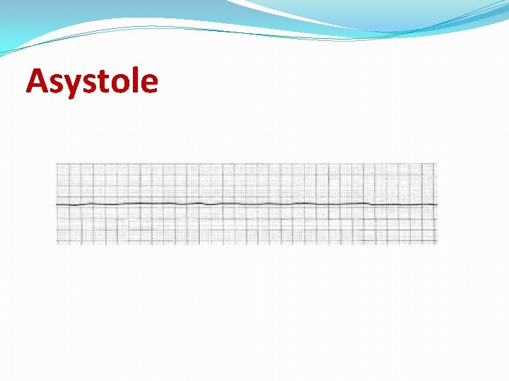 Asystole 