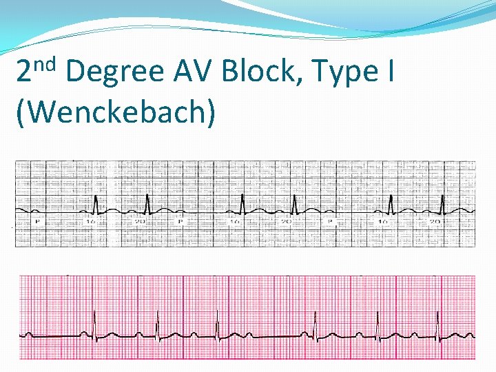 nd 2 Degree AV Block, Type I (Wenckebach) 