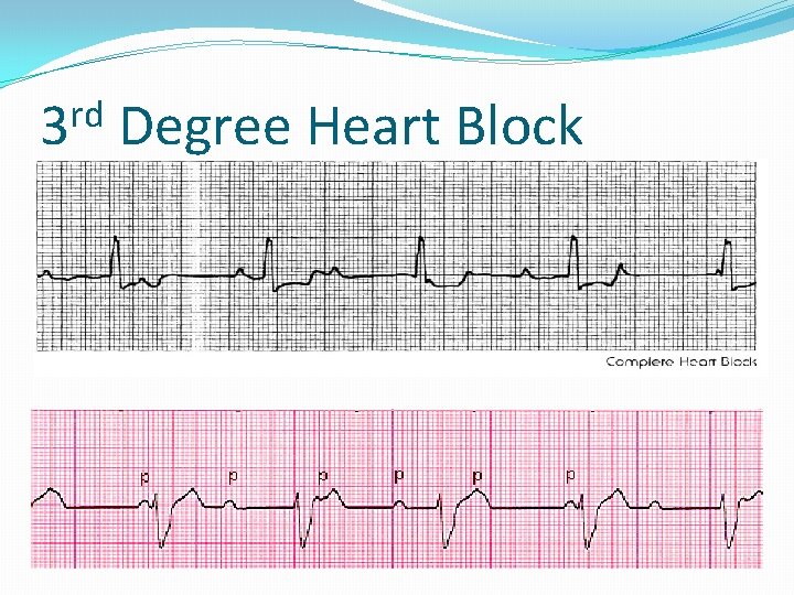 rd 3 Degree Heart Block 