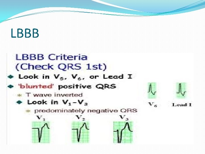 LBBB 