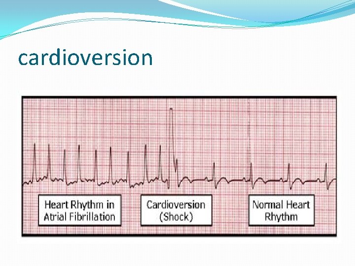 cardioversion 