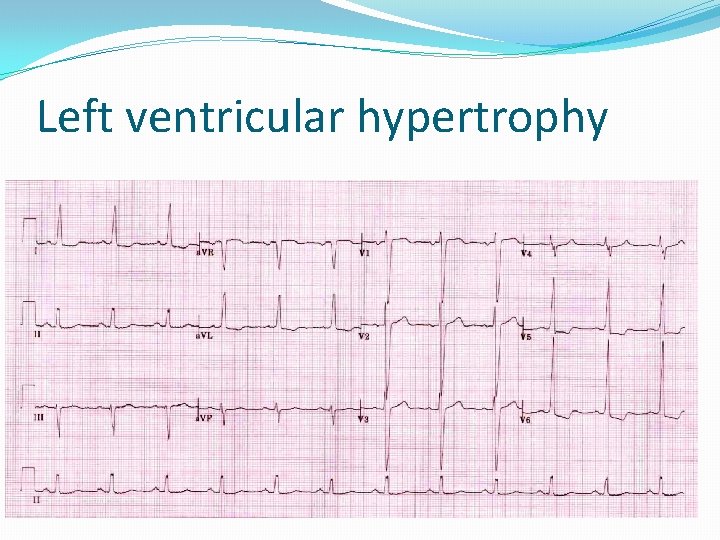 Left ventricular hypertrophy 