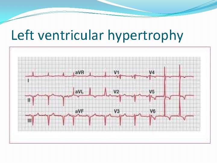 Left ventricular hypertrophy 