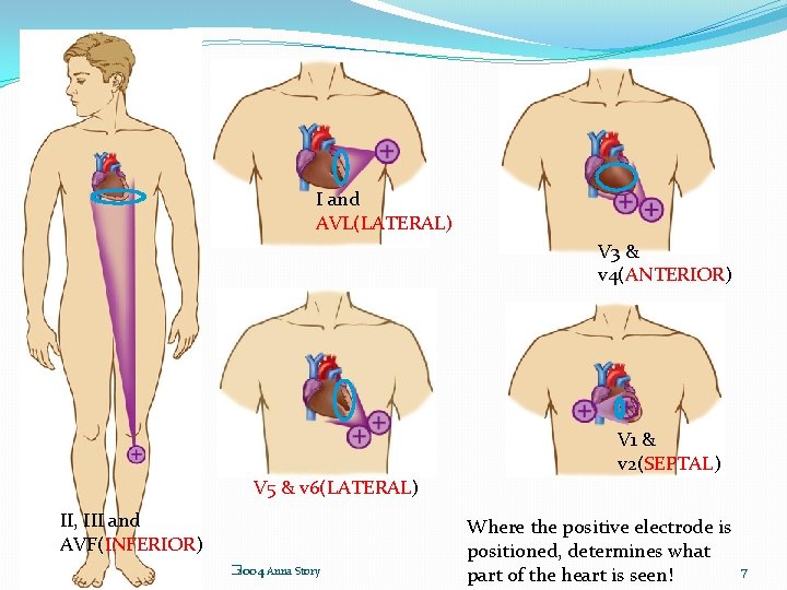 I and AVL(LATERAL) V 3 & v 4(ANTERIOR) V 1 & v 2(SEPTAL) V
