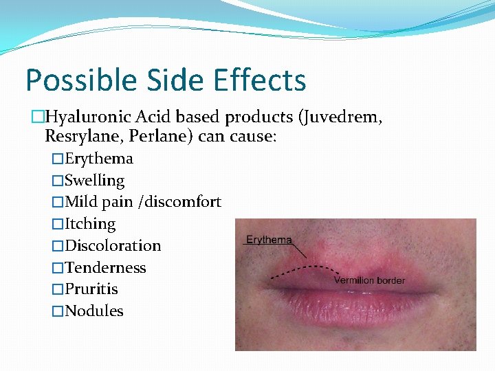 Possible Side Effects �Hyaluronic Acid based products (Juvedrem, Resrylane, Perlane) can cause: �Erythema �Swelling