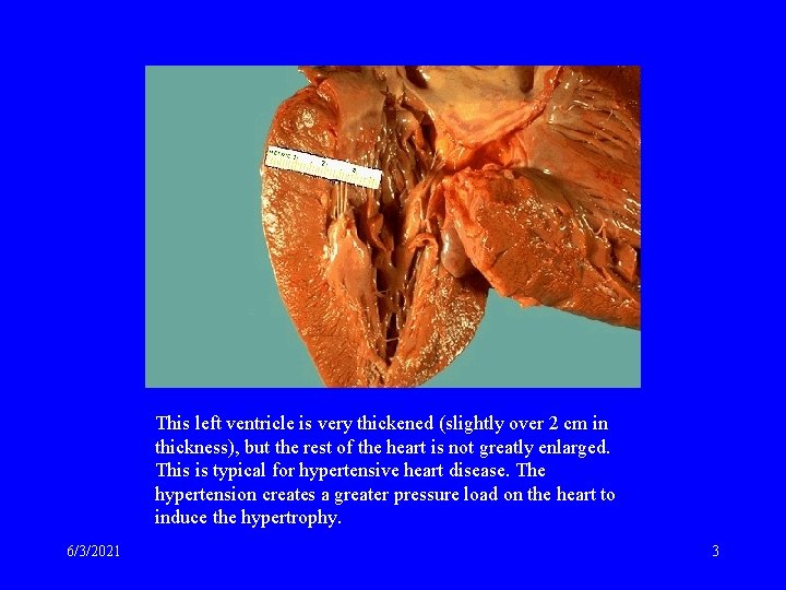 This left ventricle is very thickened (slightly over 2 cm in thickness), but the
