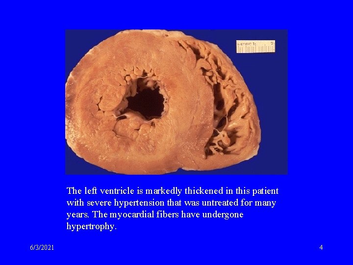 The left ventricle is markedly thickened in this patient with severe hypertension that was