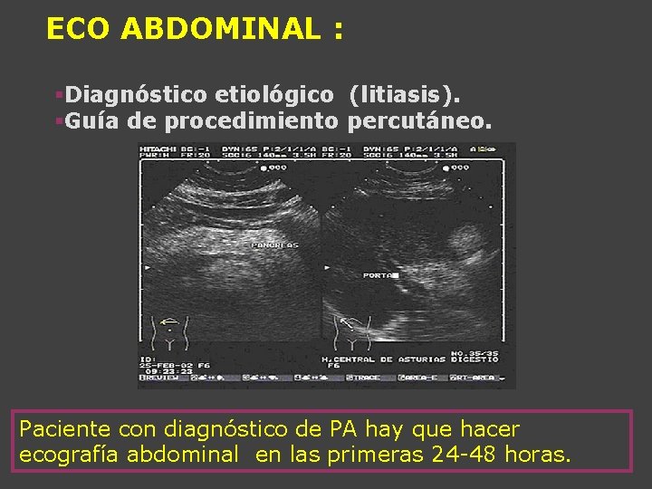 ECO ABDOMINAL : §Diagnóstico etiológico (litiasis). §Guía de procedimiento percutáneo. Paciente con diagnóstico de