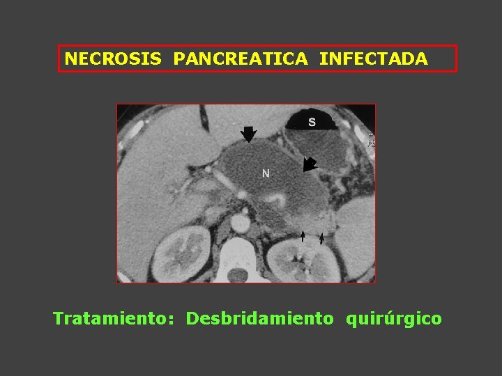 NECROSIS PANCREATICA INFECTADA Tratamiento: Desbridamiento quirúrgico 