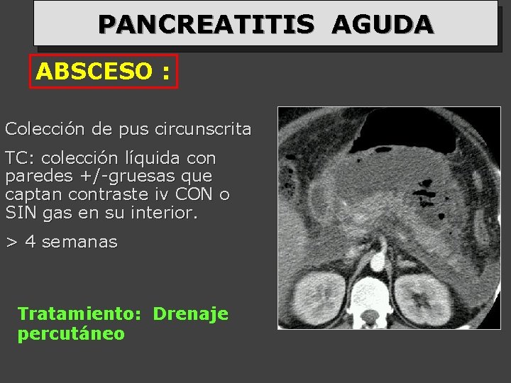 PANCREATITIS AGUDA ABSCESO : Colección de pus circunscrita TC: colección líquida con paredes +/-gruesas