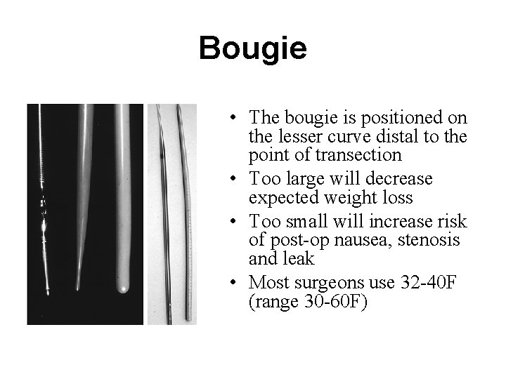 Bougie • The bougie is positioned on the lesser curve distal to the point