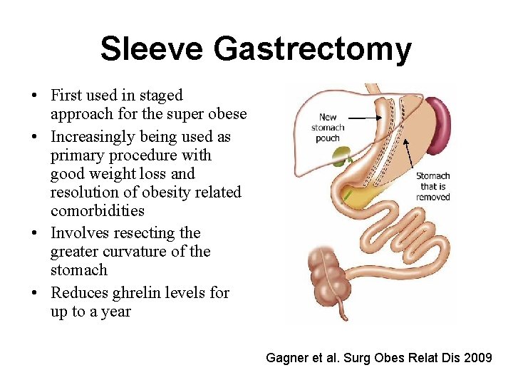 Sleeve Gastrectomy • First used in staged approach for the super obese • Increasingly
