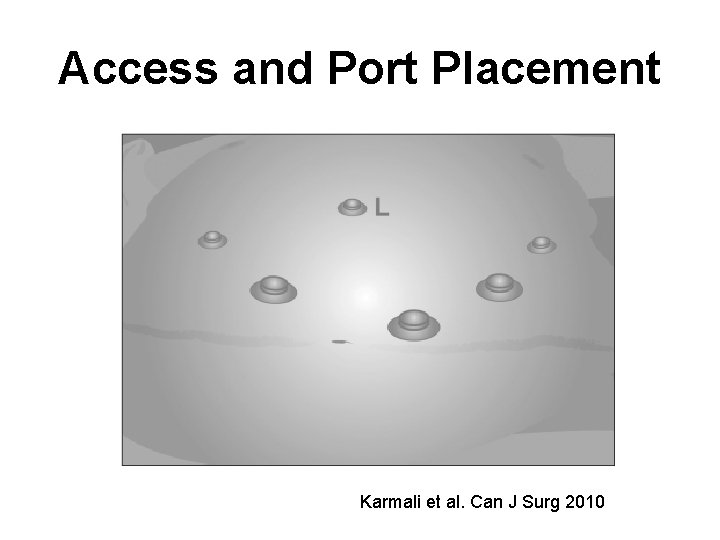 Access and Port Placement Karmali et al. Can J Surg 2010 