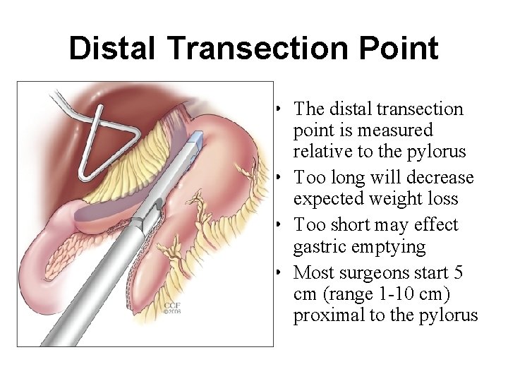 Distal Transection Point • The distal transection point is measured relative to the pylorus