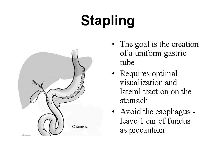 Stapling • The goal is the creation of a uniform gastric tube • Requires