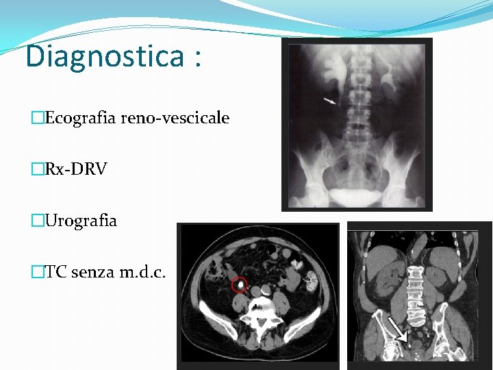 Diagnostica : �Ecografia reno-vescicale �Rx-DRV �Urografia �TC senza m. d. c. 