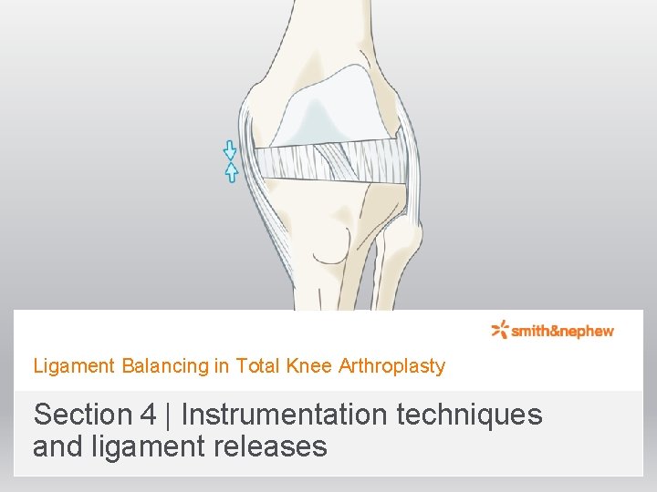 Ligament Balancing in Total Knee Arthroplasty Section 4 | Instrumentation techniques and ligament releases