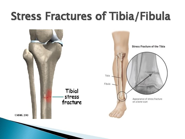 Stress Fractures of Tibia/Fibula 