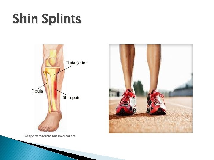 Shin Splints 