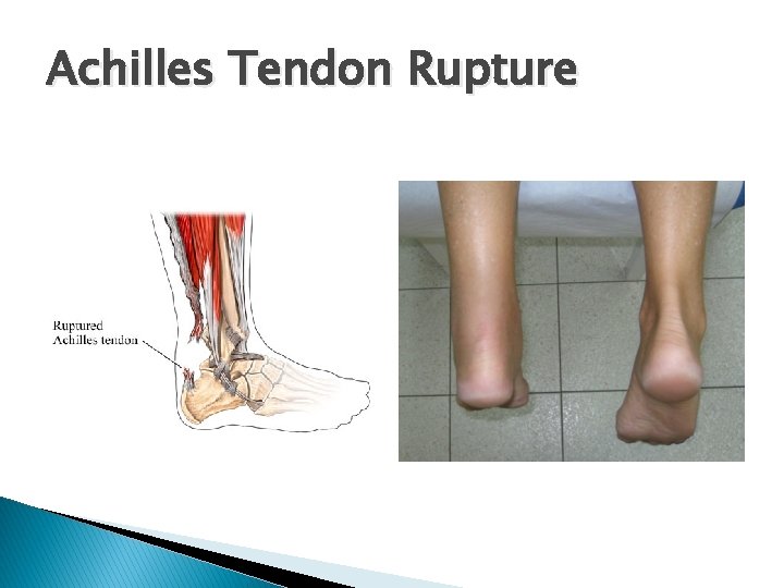 Achilles Tendon Rupture 
