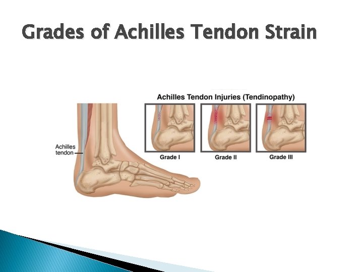 Grades of Achilles Tendon Strain 