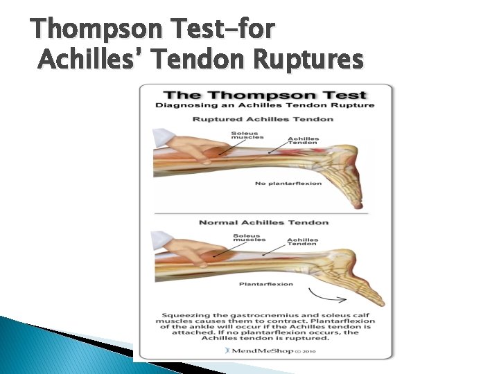 Thompson Test-for Achilles’ Tendon Ruptures 