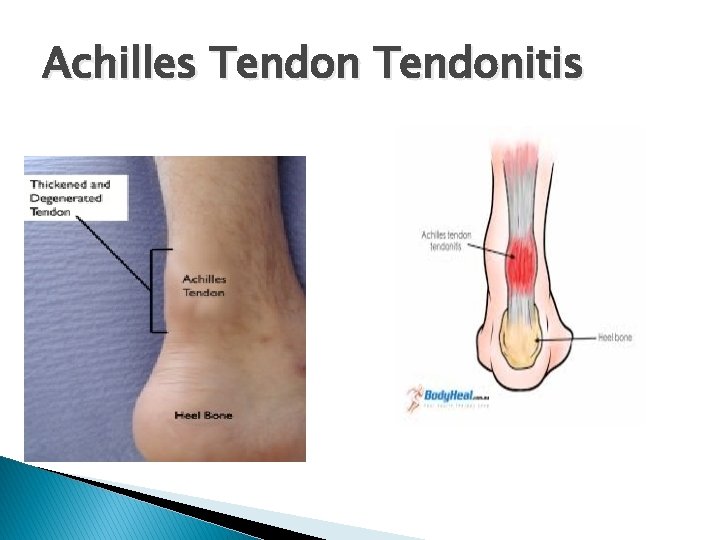 Achilles Tendonitis 