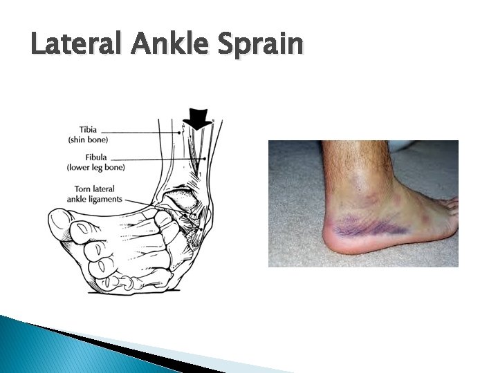 Lateral Ankle Sprain 