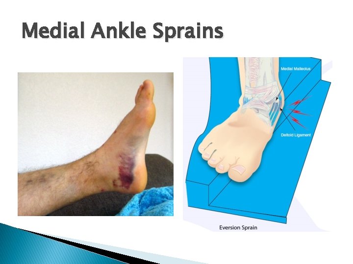 Medial Ankle Sprains 