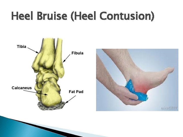 Heel Bruise (Heel Contusion) 