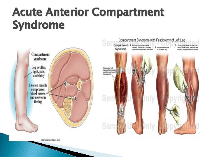 Acute Anterior Compartment Syndrome 