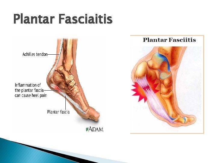 Plantar Fasciaitis 