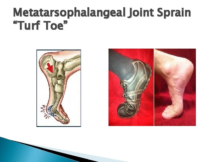 Metatarsophalangeal Joint Sprain “Turf Toe” 