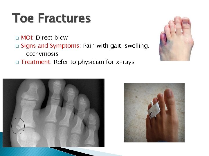 Toe Fractures � � � MOI: Direct blow Signs and Symptoms: Pain with gait,